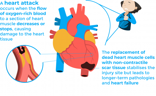 Heart attack infographic: a heart attack occurs when the flow of oxygen-rich blood to a selection of heart decreases or stops causing damage to the heart tissue